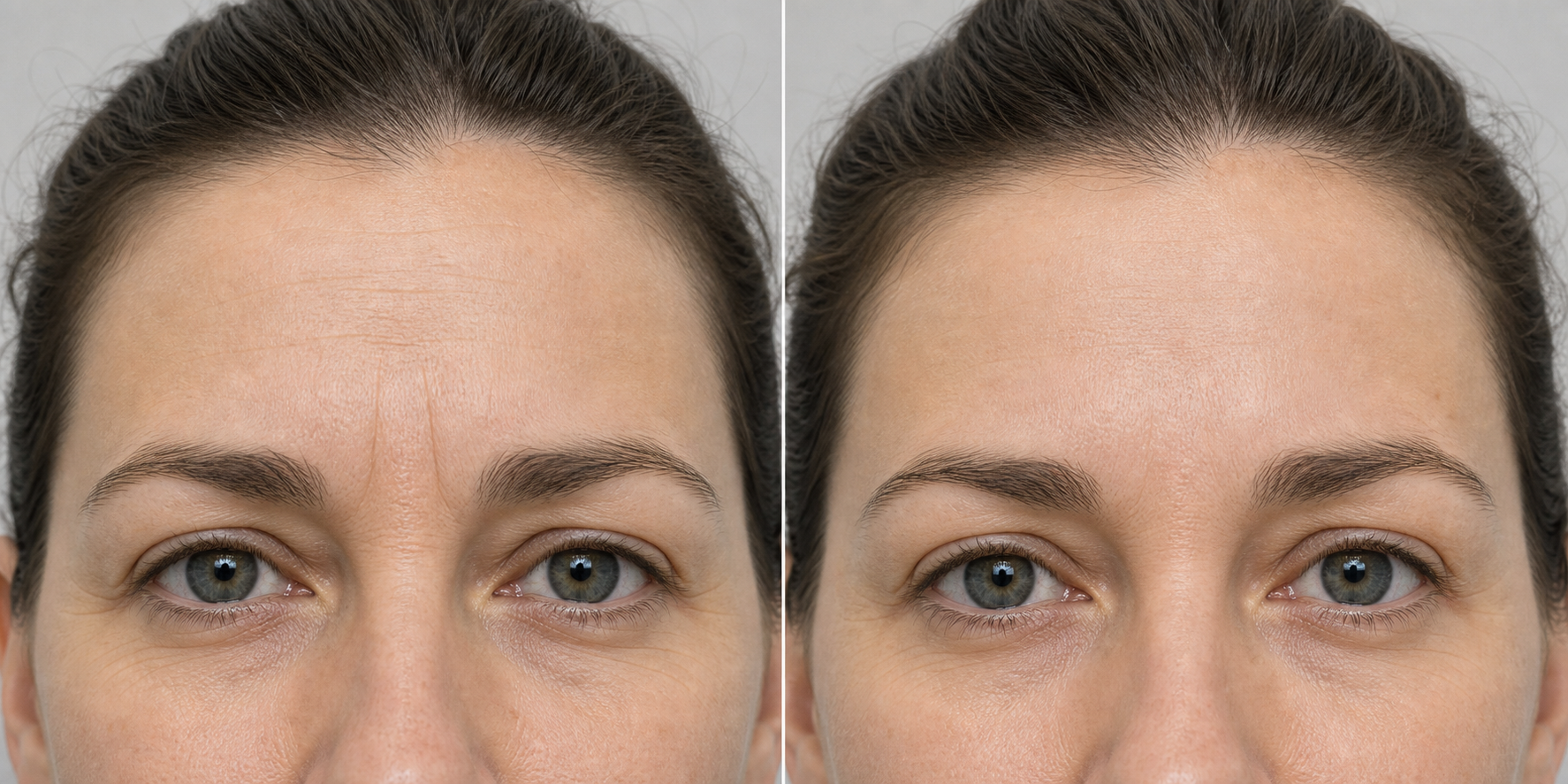 Illustrative relaxed before and after showing softened 11 lines and crow's feet